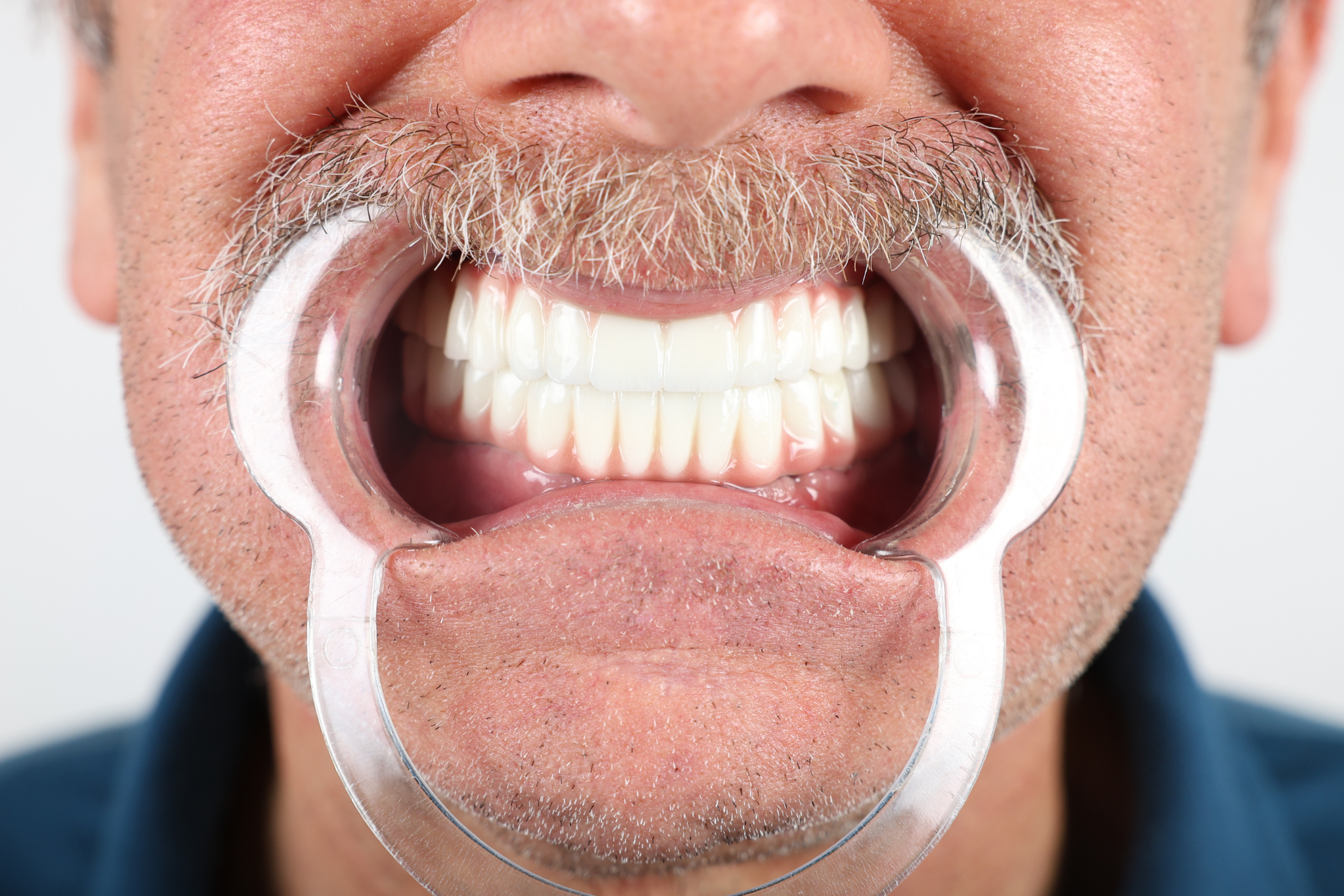 After All-on-6 Implant Treatment